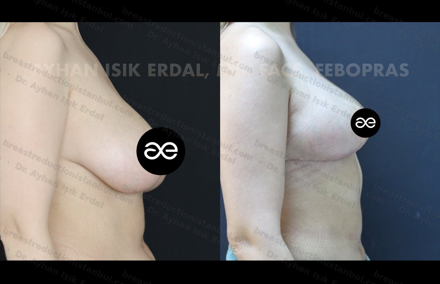 Case 1 lateral view - pre-op and 2 months post-op