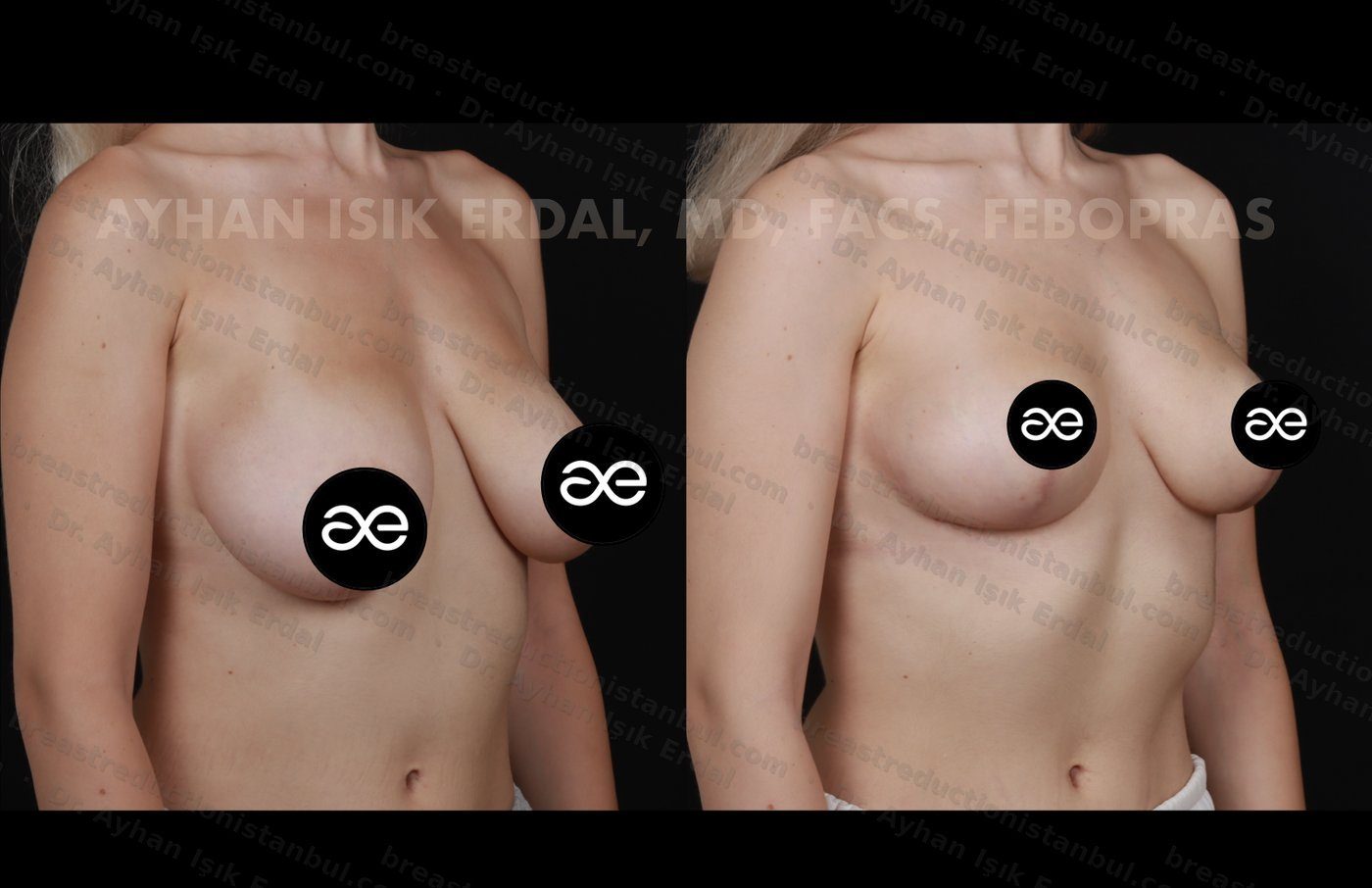 Case 4 oblique view - pre-op and 2 months post-op